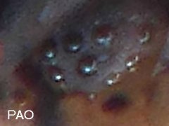 Setanodosa afurcata? ♀ (Collembola) from Australia
Eyepatch with 8 ocelli
Post-antennal organ (PAO) with 5 peripheral lobes
2018.08.15 © Vale, E.